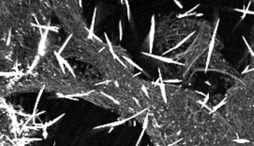 Human lung tissue with asbestos bodies
